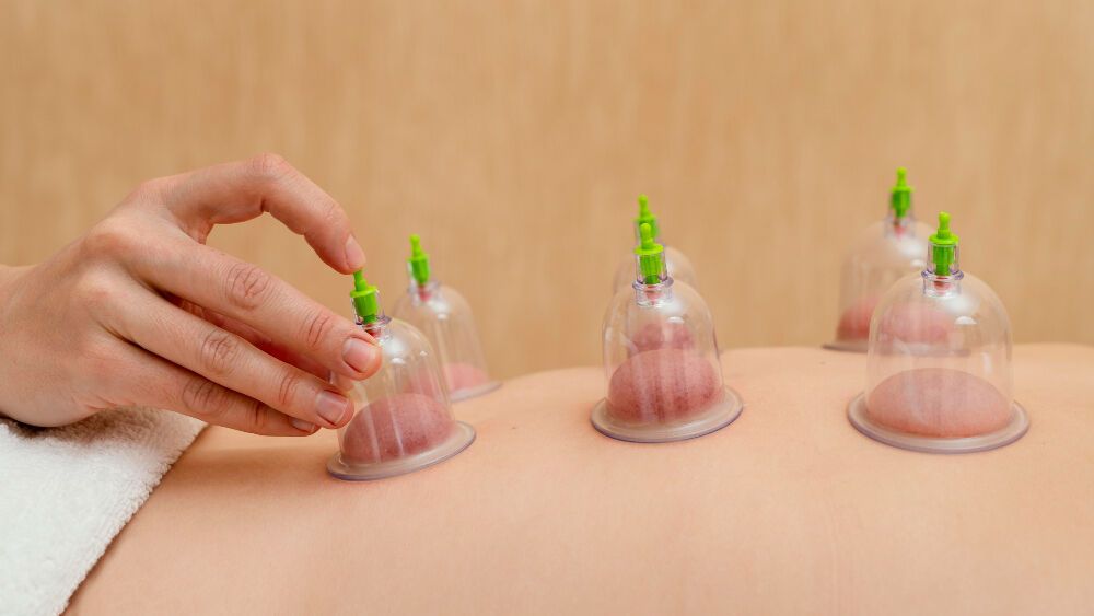 Hacamat (Cupping Therapy) Nedir? 