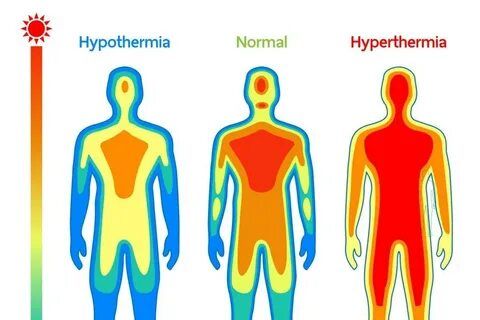 Hipertermi (Vücut Hipertermisi) Nedir?