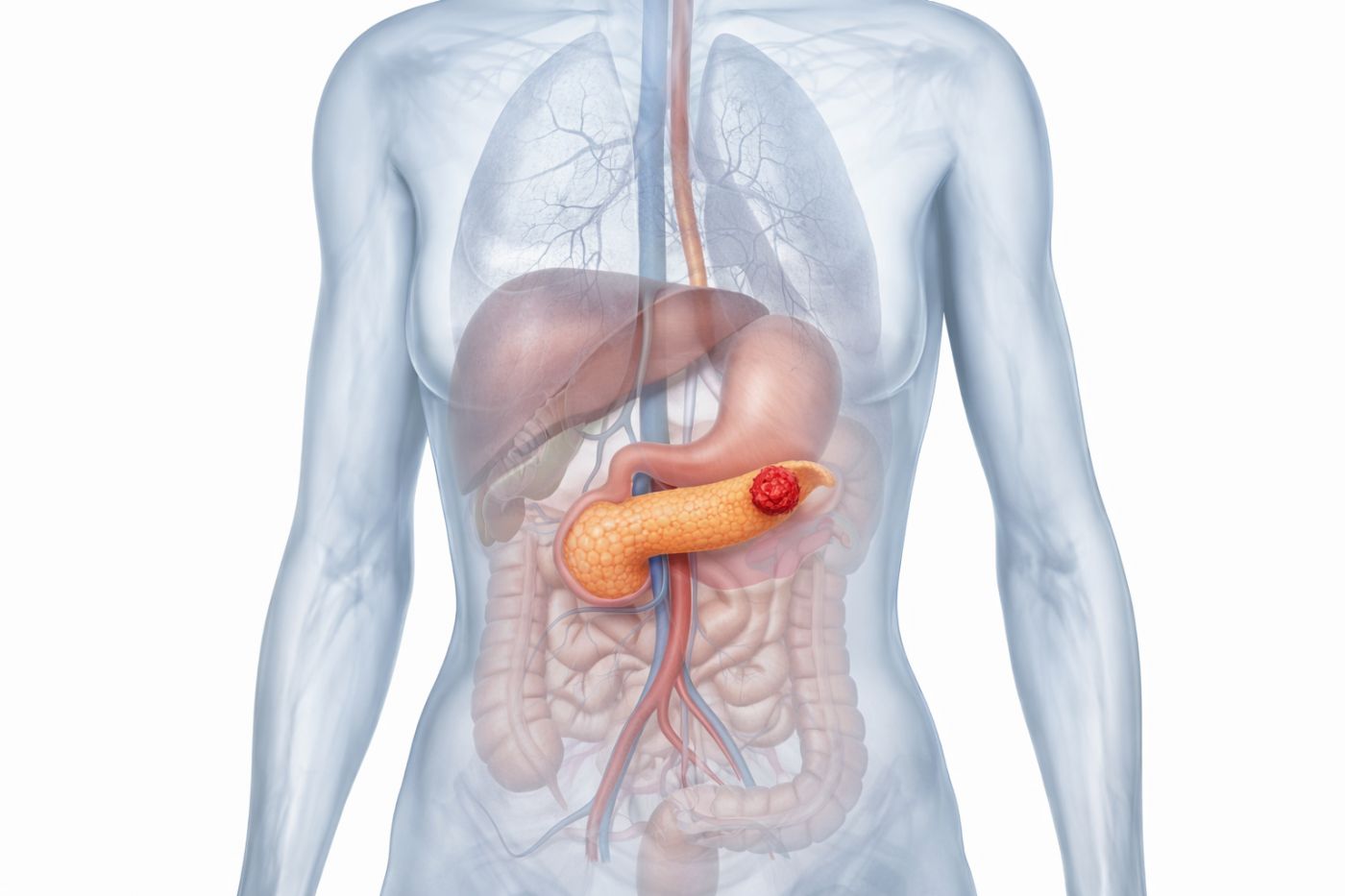 Pankreas Nöroendokrin Tümörü