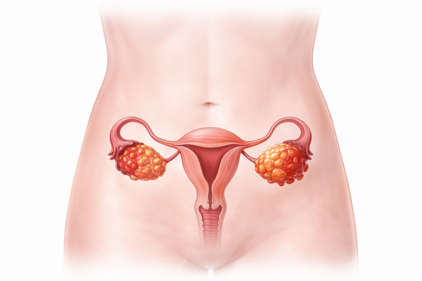 Over (Yumurtalık) Kanseri