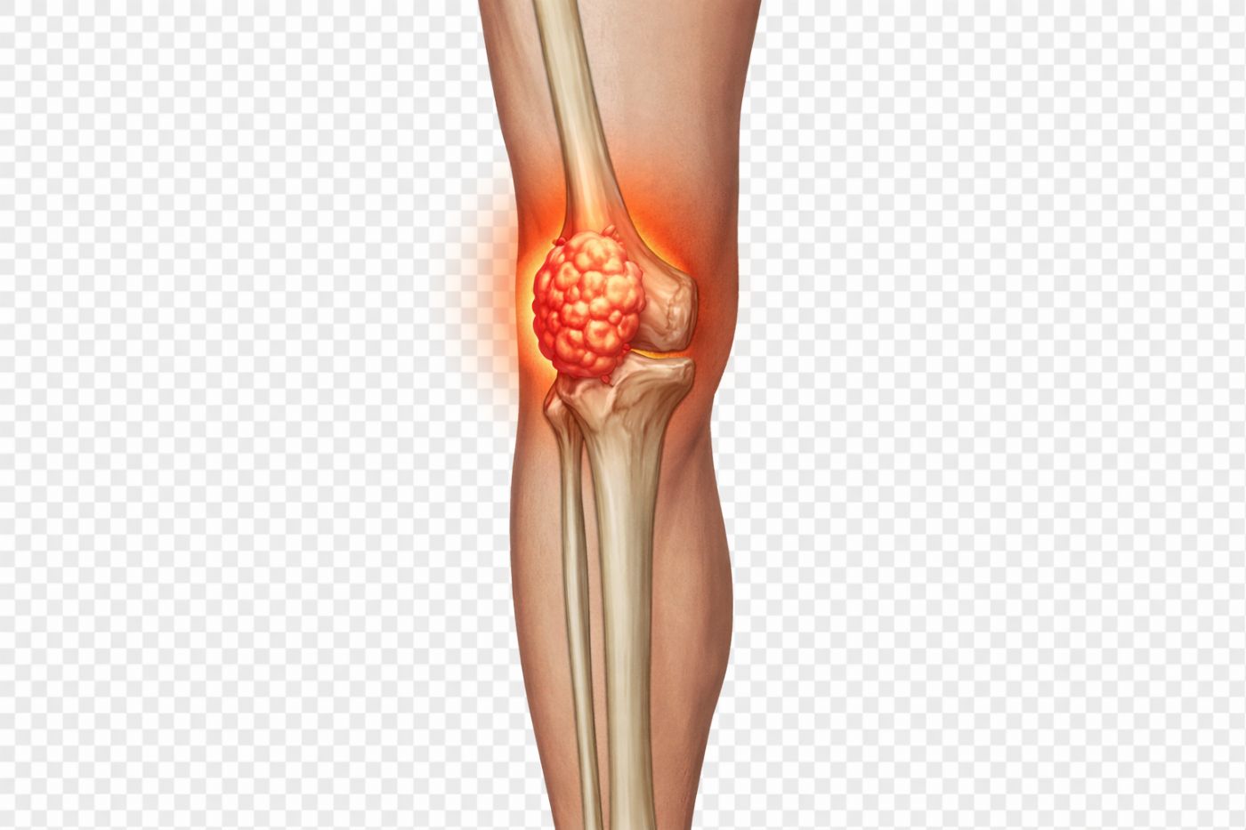 Kemik Kanseri (Osteosarkom)