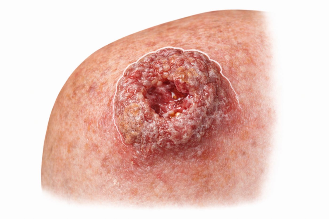 Cilt Kanseri Skuamöz Hücreli